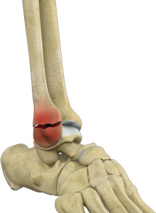 Ankle Fracture Surgery Seacoast Orthopedics & Sports Medicine, Newburyport,  MA, ankle fracture