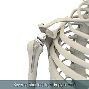 Reverse Total Shoulder Arthroplasty