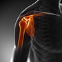 Shoulder Ligament Reconstruction