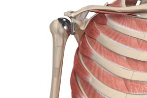 Anatomic Total Shoulder Arthroplasty